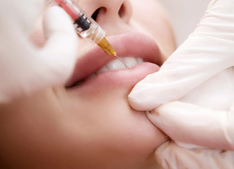 Hyaluronic Acid Fillers for Lips