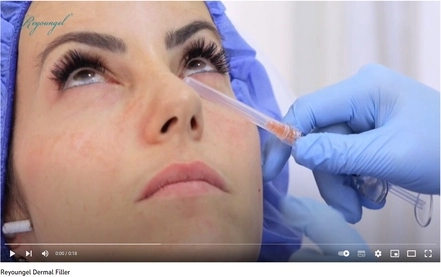 Reyoungel Dermal Filler